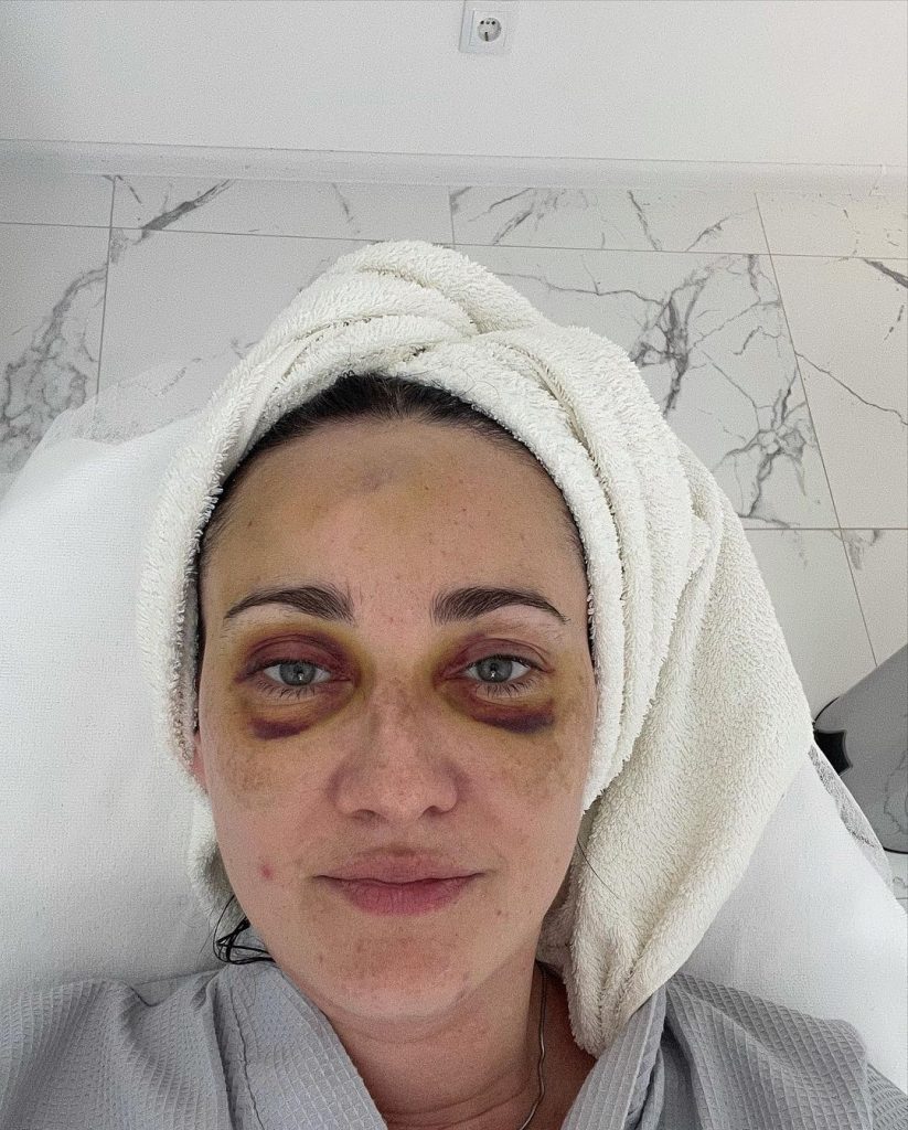Соломия Витвицкая показала, как гримировали ее жуткие синяки на лице после ДТП 